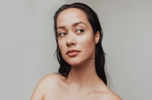 10 Natural Ways to Get Rid of Acne