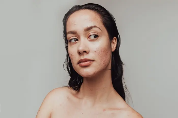 10 Natural Ways to Get Rid of Acne